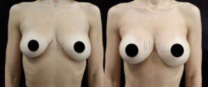 Breast Augmentation Patient 102 Before & After - Thumbnail