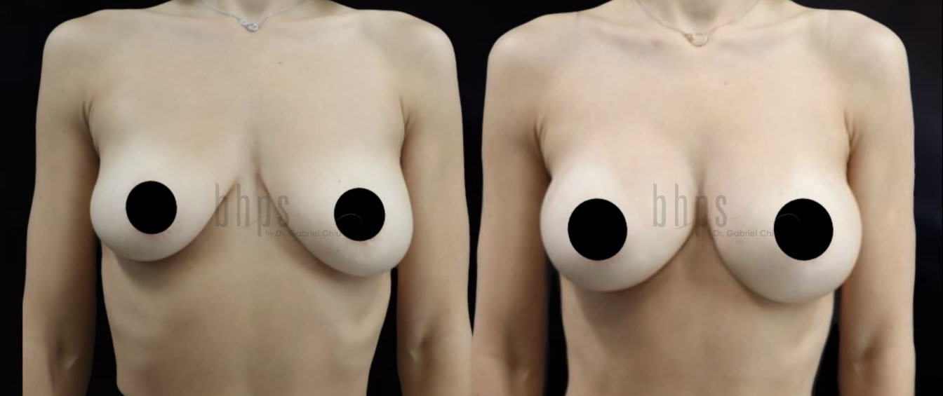 Breast Augmentation Patient 102 Before & After