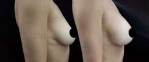 Breast Augmentation Patient 102 Before & After - Thumbnail