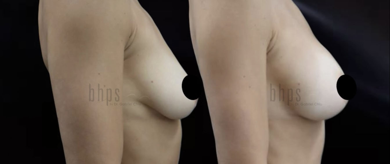 Breast Augmentation Patient 102 Before & After