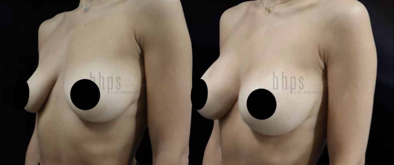 Breast Augmentation Patient 102 Before & After