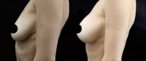 Breast Augmentation Patient 102 Before & After - Thumbnail