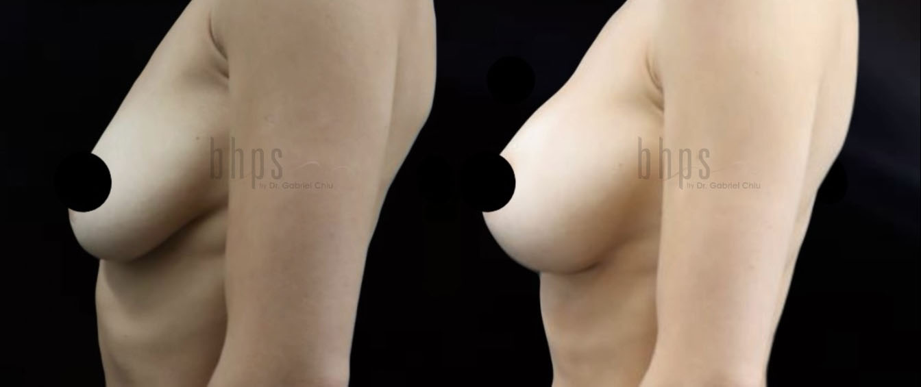 Breast Augmentation Patient 102 Before & After