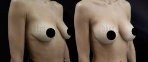 Breast Augmentation Patient 102 Before & After - Thumbnail