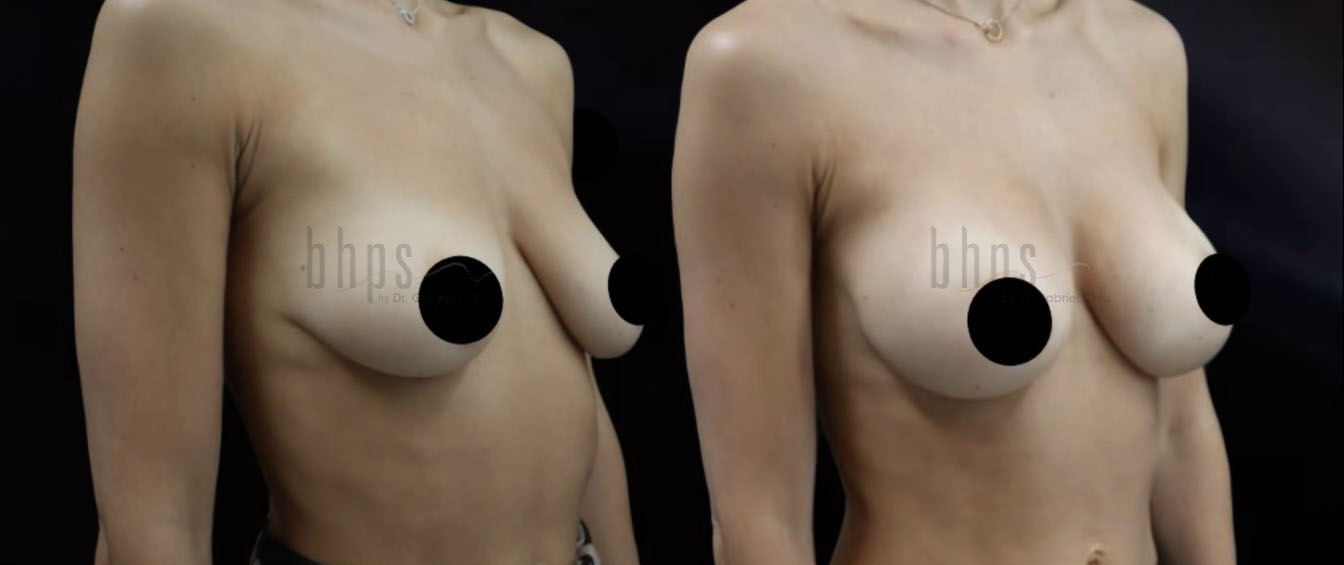 Breast Augmentation Patient 102 Before & After