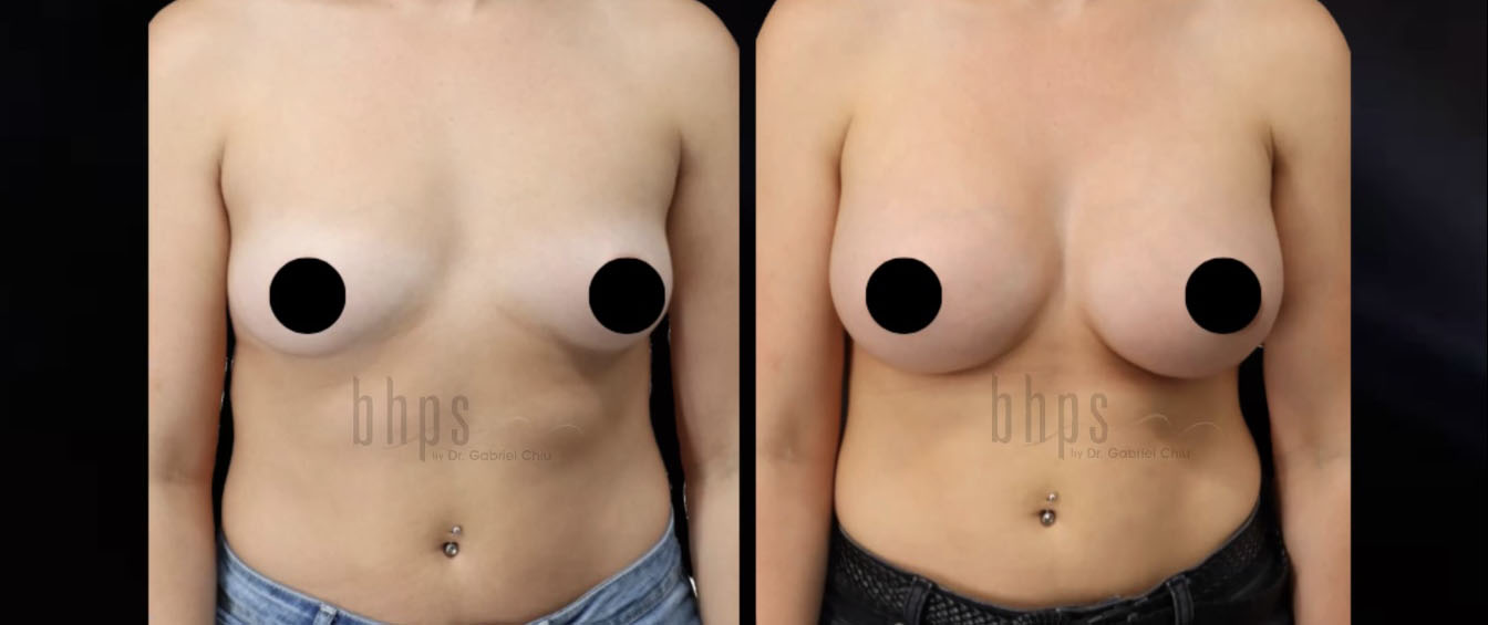 Breast Augmentation Patient 101 Before & After