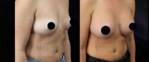 Breast Augmentation Patient 101 Before & After - Thumbnail