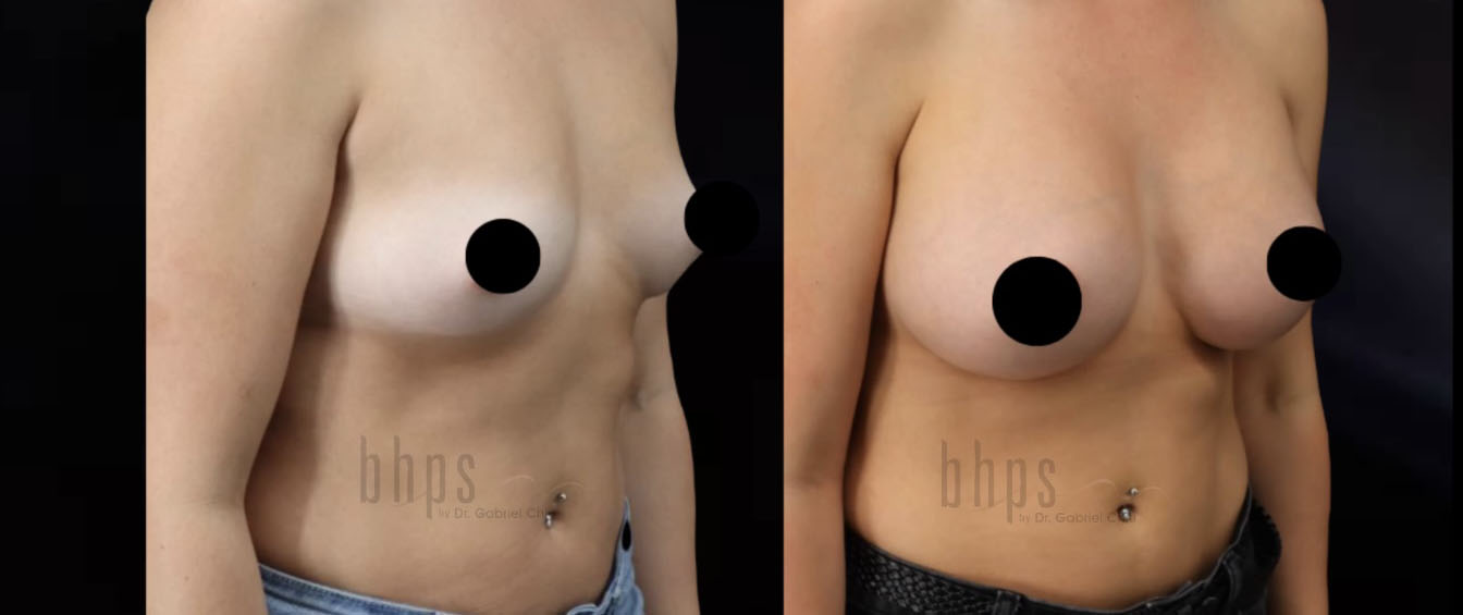 Breast Augmentation Patient 101 Before & After