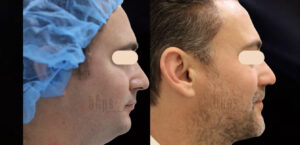 Chin Implants Patient 01 Before & After - Thumbnail