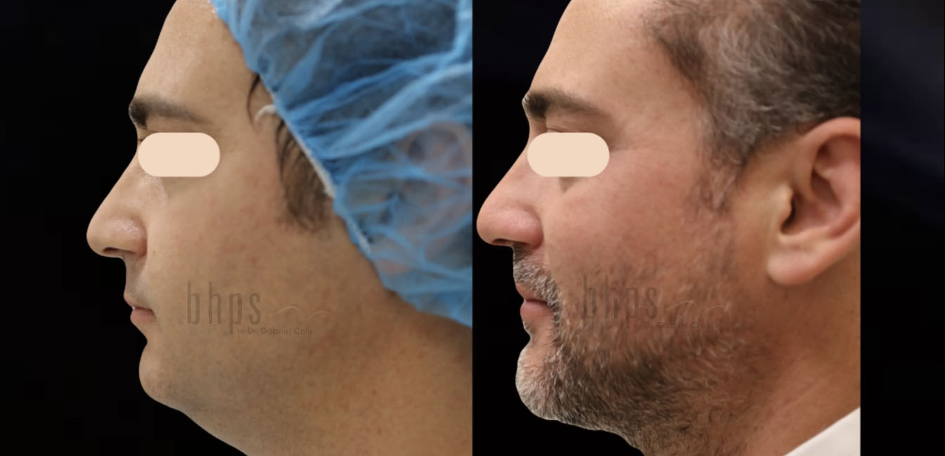 Chin Implants Patient 01 Before & After