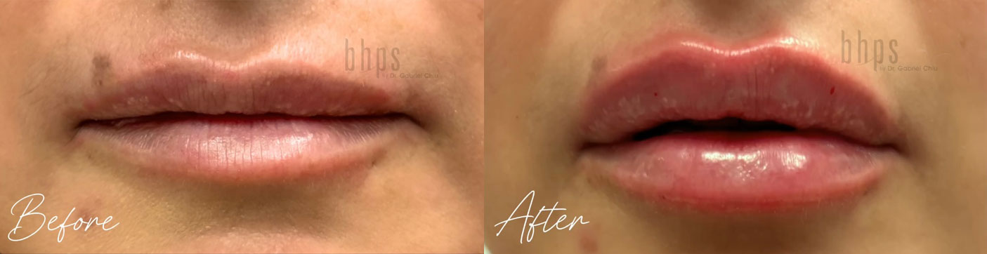 Lip Filler Patient 01 Before & After