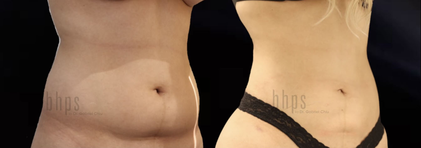 Liposuction Patient 58 Before & After