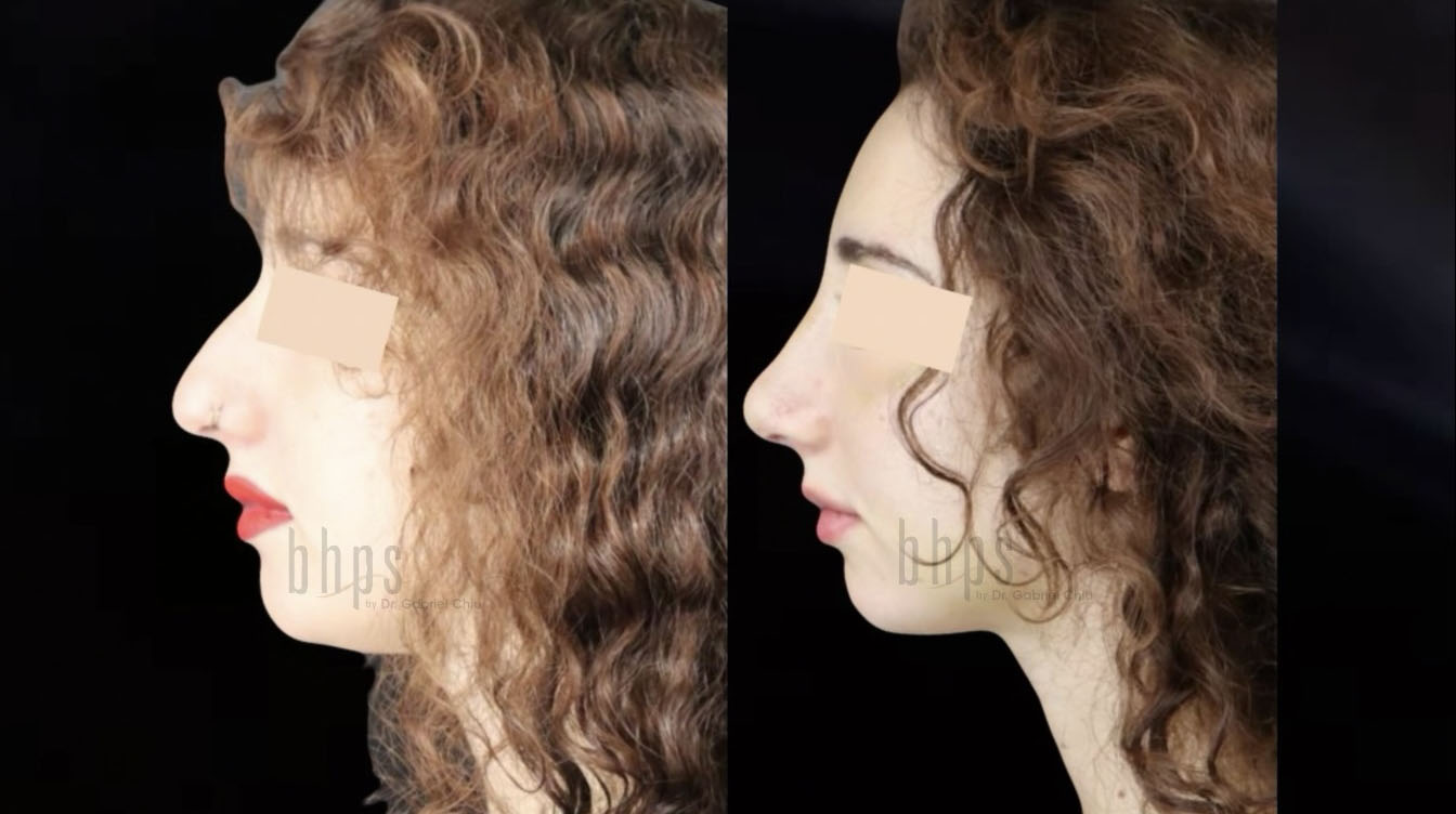 Rhinoplasty Patient 38 Before & After